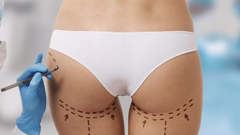 Las tres fases del BBL: liposucción de zonas donantes, purificación y transferencia de grasa a glúteos