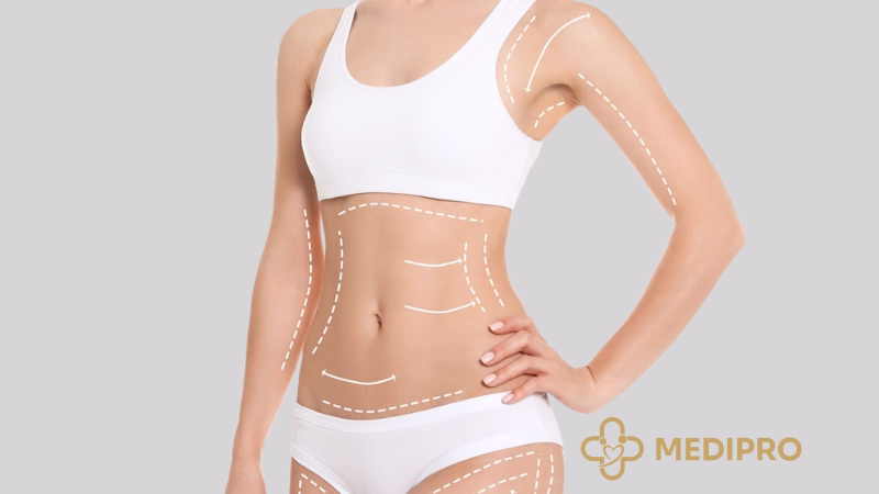 Paciente en recuperación postoperatoria de liposucción con faja de compresión