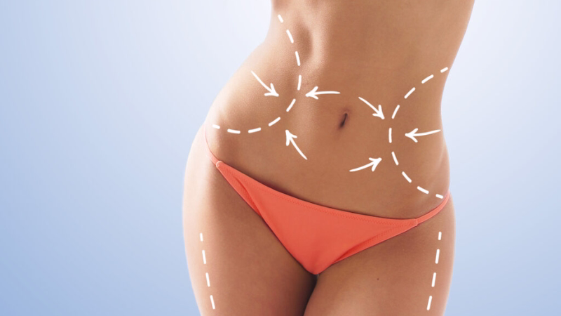 Resultado de liposucción: silueta definida y contorneada