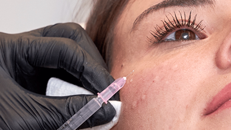 Marcas de ácido hialurónico certificadas para rellenos faciales en Colombia