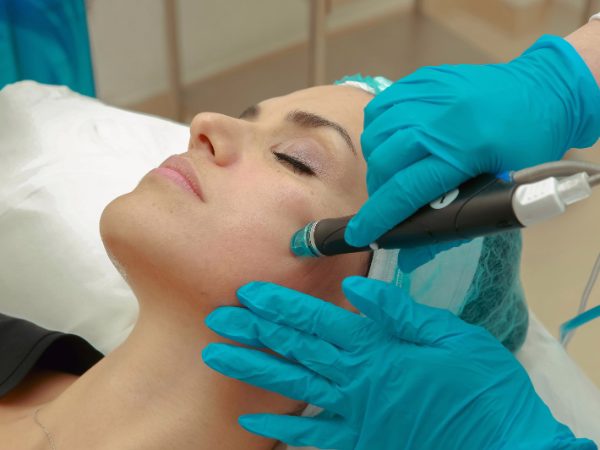 Resultado de tratamiento para cicatrices de acné mostrando textura de piel mejorada